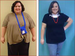Gastric Bypass Surgery In America